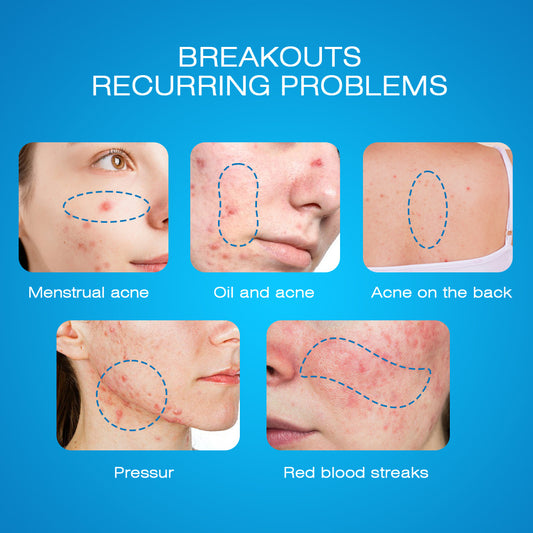 Sumifun Brightening Cream for Acne Scar Skin Treatment